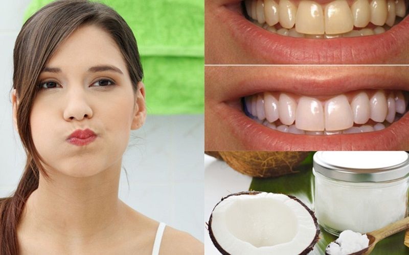 Chuẩn bị:  - 1 muỗng canh (khoảng 10–15ml) dầu dừa nguyên chất (loại ép lạnh – extra virgin coconut oil)  - Thời gian: khoảng 10–15 phút mỗi sáng khi bụng đói  Các bước thực hiện:  - Ngậm dầu dừa trong miệng  – Lấy khoảng 1 muỗng canh dầu dừa, đưa và