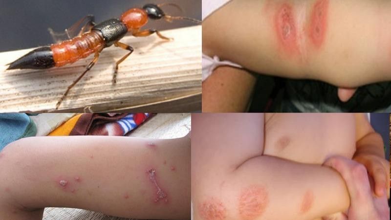 Những điều cần biết khi bị kiến ba khoang cắn 
