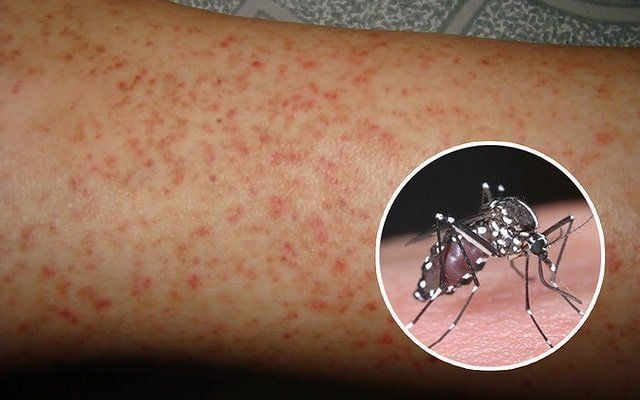 Bệnh sốt xuất huyết: Nguyên nhân và triệu chứng cần biết