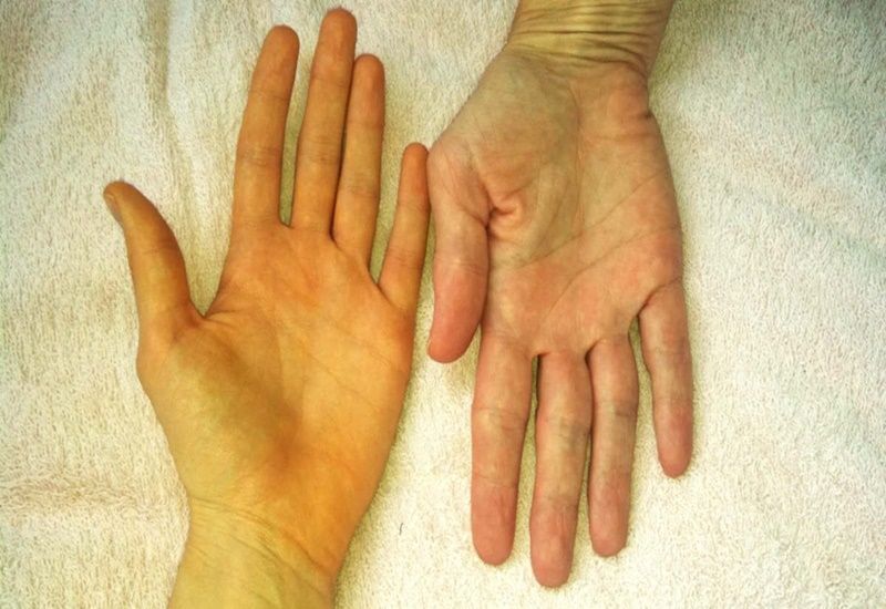 nhiều người có thể bị vàng da tạm thời do ăn quá nhiều thực phẩm chứa beta-carotene – một tình trạng lành tính và không gây tổn hại sức khỏe. Việc phân biệt rõ vàng da do thực phẩm và vàng da do bệnh lý là vô cùng cần thiết để tránh nhầm lẫn, lo âu k