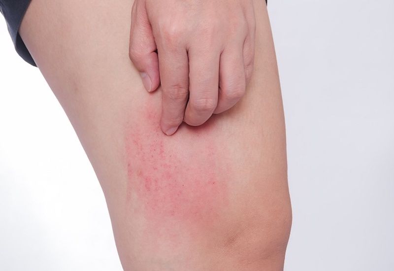  Chữa viêm da, mẩn ngứa, lở loét ngoài da