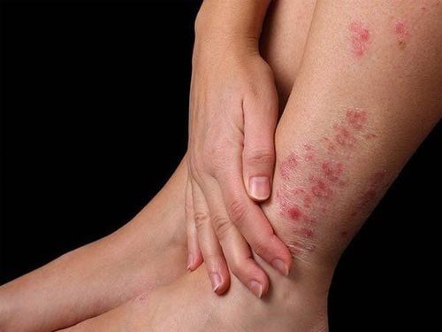Một số bệnh da liễu thường gặp trong mùa mưa 