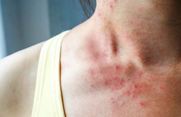 Một số bệnh da liễu thường gặp trong mùa mưa 