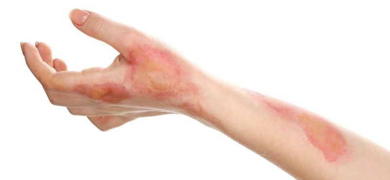 au khi ngắt điện, gọi cấp cứu và kiểm tra phản ứng ban đầu, việc xử lý các tổn thương trên cơ thể – đặc biệt là vết bỏng do điện – là bước quan trọng tiếp theo để hạn chế biến chứng và nhiễm trùng.